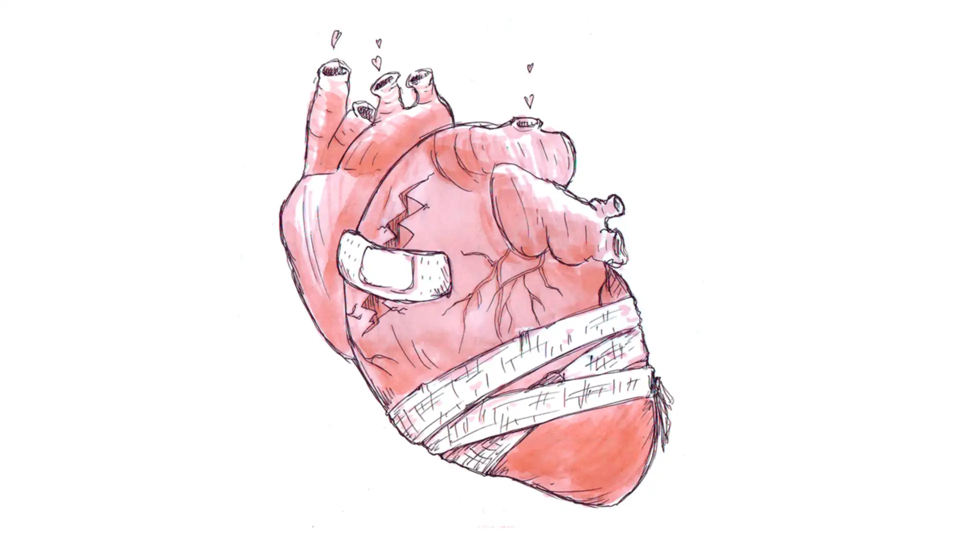 Bipolar Disorder Girl Story