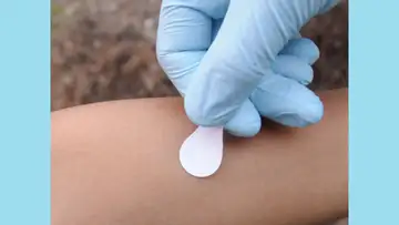 Microneedle Patch