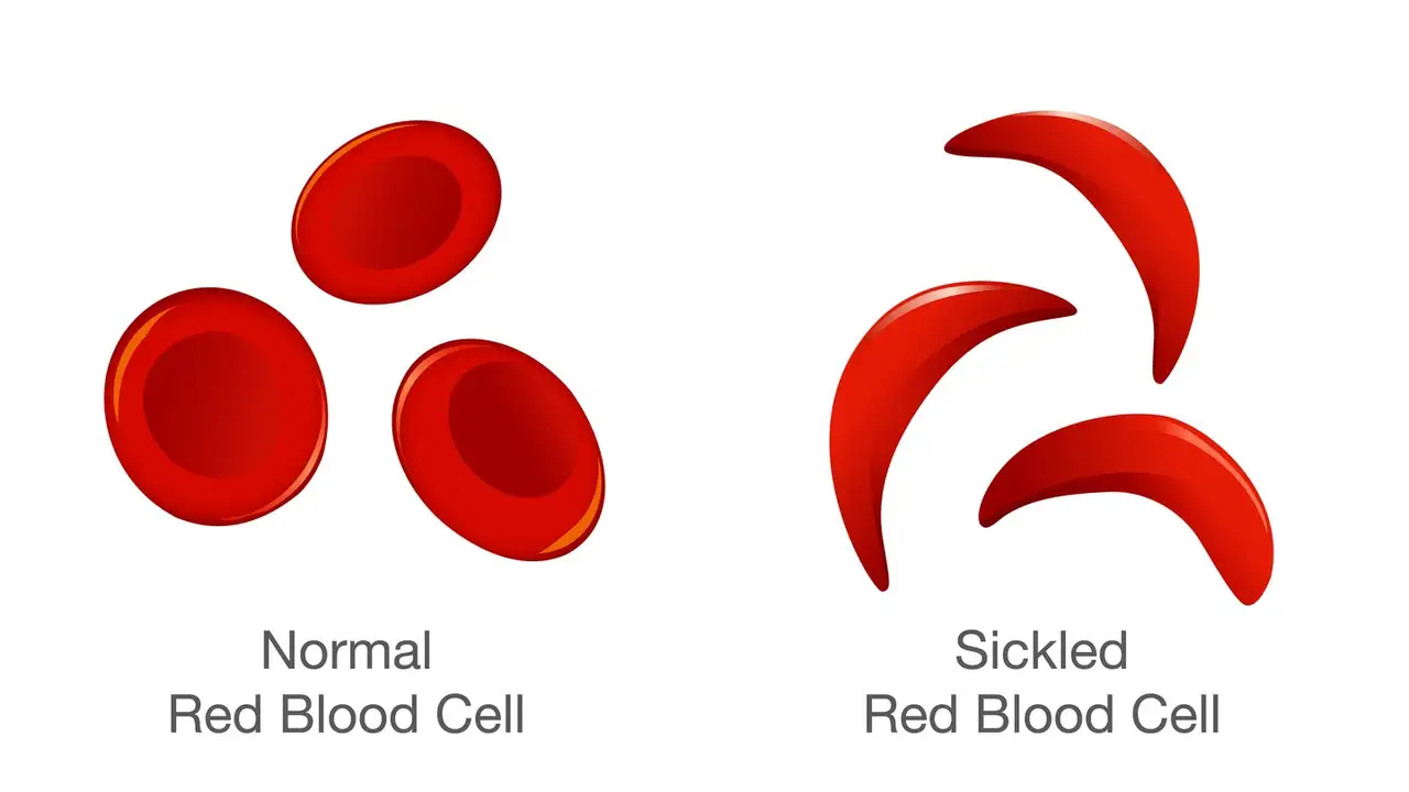 Listen Half of Sickle Cell Patients Don’t Get An Easy Screening that ...