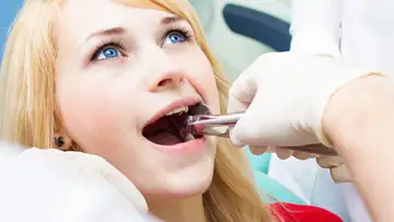 Wisdom Teeth