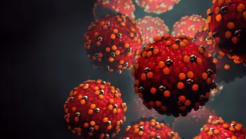 Measles