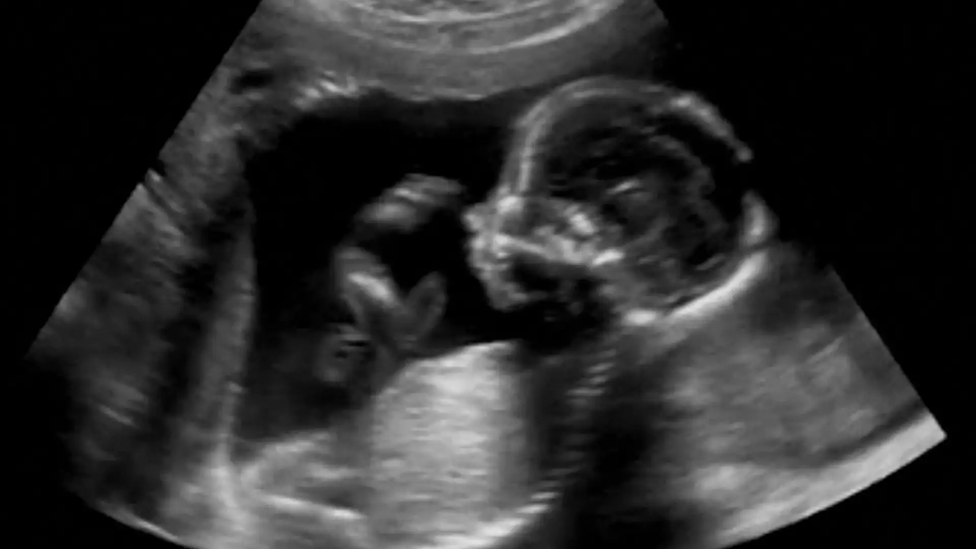 Fetal Surgery