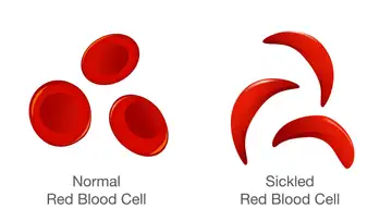 Sickle Cell Inequity