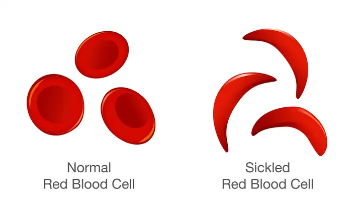 Sickle Cell Inequity