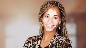 Vitiligo Empowerment