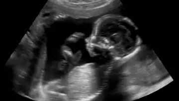 Fetal Surgery