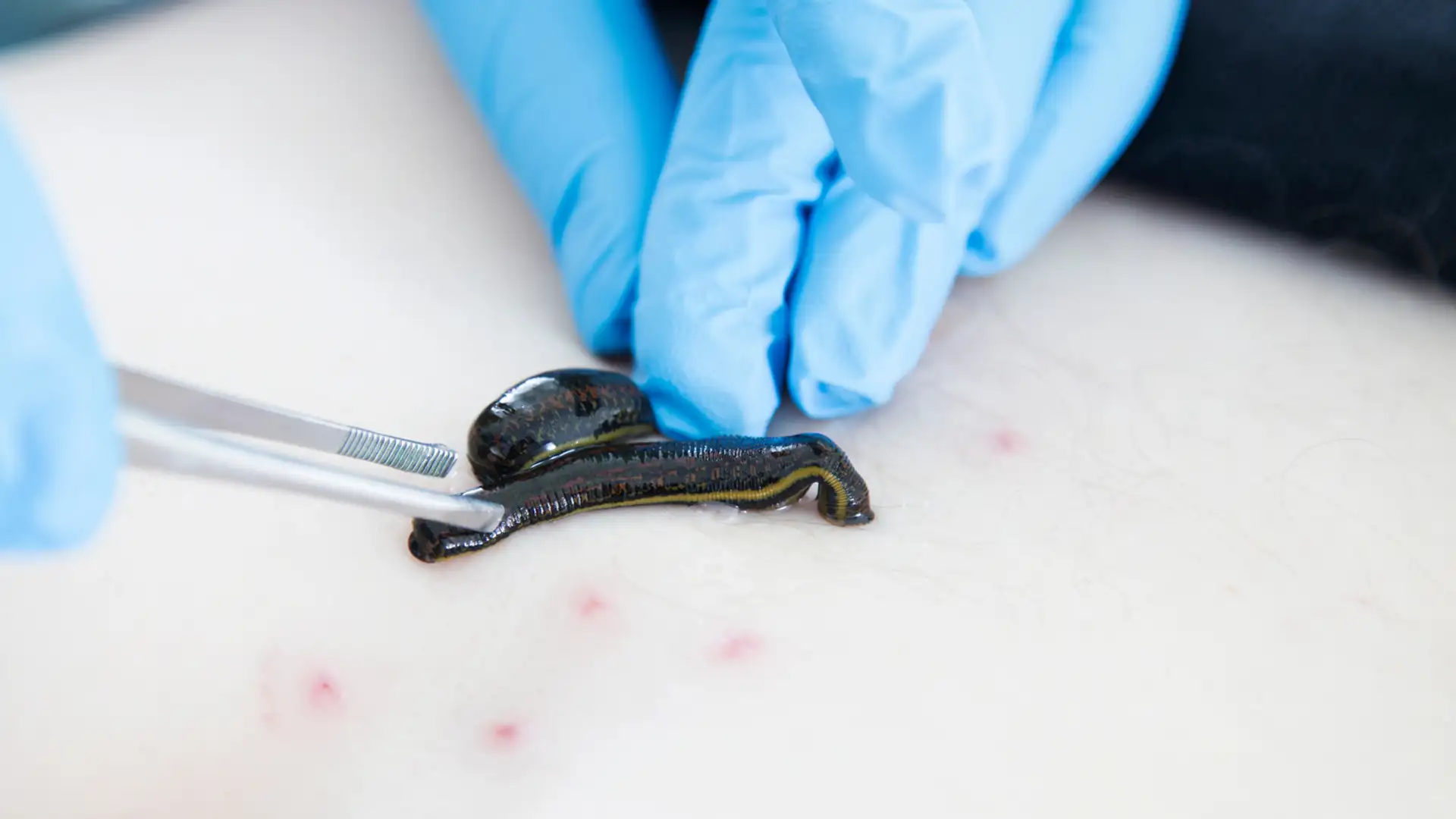 Medical Leeches