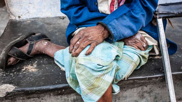 Leprosy Myths