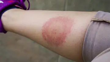 A Better Treatment for Lyme Disease?